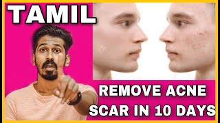 REMOVE ACNE SCAR IN 10 DAYS  TAMIL  HOUSE OF MAVERICK [upl. by Phip]