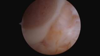 Arthroscopic autograft OATS procedure [upl. by Malan]