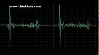 Mitral Regurgitation moderate [upl. by Llennod]