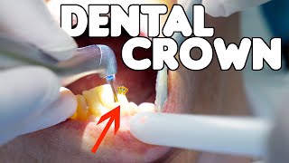 Dental Crown Procedure EXPLAINED [upl. by Finnigan178]