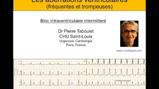 4h Aberration ventriculaire bloc de branche ou ESV  ECG Dr Taboulet [upl. by Uyekawa]