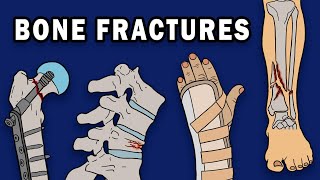 BONE FRACTURES [upl. by Inimak902]