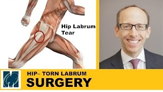 Hip Pain  Torn Labrum Hip [upl. by Bartholomeus814]