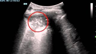 QA lung consolidation ultrasound [upl. by Naujad631]