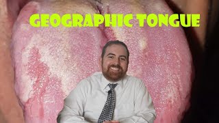 Geographic Tongue A Clinical Review [upl. by Yovonnda158]