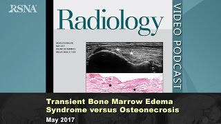 Transient Bone Marrow Edema Syndrome versus Osteonecrosis May 2017 Radiology [upl. by Zetrac]