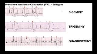 EKG Patterns  Premature Atrial amp Ventricular Contractions PACs amp PVCs [upl. by Trinl]