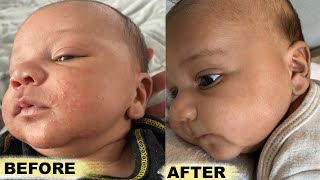 How To Get Rid Baby Acne FAST [upl. by Frodi]