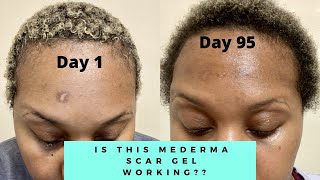 IS THIS MEDERMA WORKING  MEDERMA ADVANCED SCAR GEL 3 MONTH UPDATE  NIJAH J [upl. by Arod]