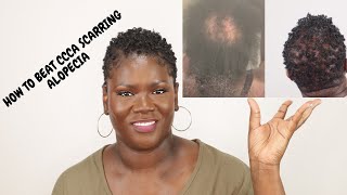 5 things that really work for CCCA or scarring alopecia [upl. by Liss]