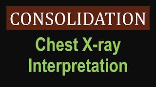 Lung Consolidation  Chest Xray Interpretation [upl. by Norabel]