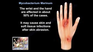 Mycobacterium Marinum  Everything You Need To Know  Dr Nabil Ebraheim [upl. by Gerg864]