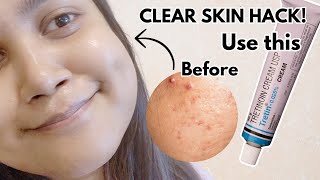 How to Use Tretinoin Correctly Before amp After Results [upl. by Procto849]