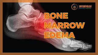 BONE MARROW EDEMA TREATMENTS [upl. by Adyan]