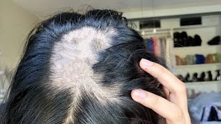 Im going bald  Alopecia Areata What I did to grow my hair [upl. by Bluefield159]