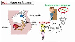 Painful Bladder Syndrome PBS  Interstitial Cystitis IC [upl. by Anil]