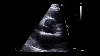 Peripartum Aortic Dissection Echocardiogram [upl. by Anayik]