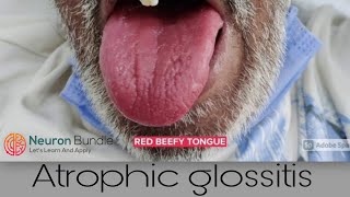 Atrophic glossitis BeefyRedTongue medschool clinicalexamination [upl. by Eedyah]