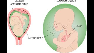 Meconium Aspiration Syndrome and HIE [upl. by Atterg]