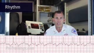 Atrial Fibrillation ECG Rhythm Interpretation [upl. by Mil587]