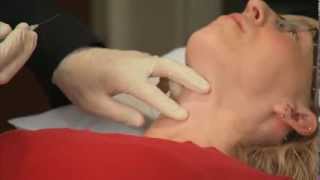 Treating Chronic Headaches with BOTOX Injections [upl. by Annodal]