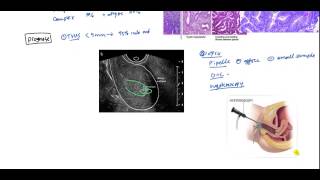 How is Endometrial Cancer Diagnosed [upl. by Ahsiekram491]