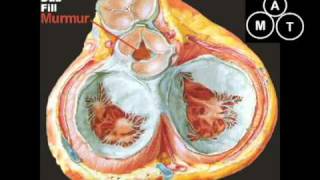 Animated Aortic Regurgitation Murmur [upl. by Oilut]