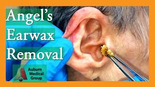 Angels Earwax Removal  Auburn Medical Group [upl. by Ollayos]