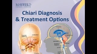 Arteriovenous Malformation Treatment at Carilion Clinic [upl. by Salokin]