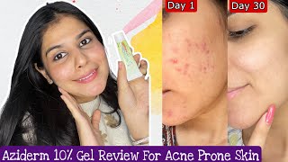 How To Treat Acne Scars  Aziderm 10 Cream Review [upl. by Giulia]