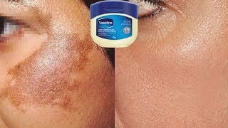 How To Use Vaseline To Remove Skin Pigmentation In Just 10 Days  Home Remedies [upl. by Sibylla]