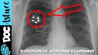 🔴 5 Dr Astuce  APPRENDS LE SYNDROME ALVEOLAIRE EN  DE 5 MIN  partie 1  Dr Astuce [upl. by Alyek]