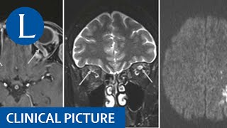 2 What are the Symptoms of Encephalitis [upl. by Mayes608]