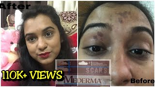 mederma cream review how to remove acne scar and stretch mark naturally live demo with mederma [upl. by Bobinette]