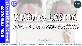 Median rhomboid glossitis  Kissing lesion  Central papillary atrophy  Dr Paridhi Agrawal [upl. by Eivad]