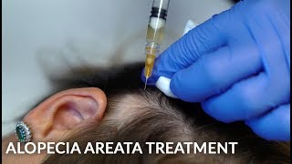 PRP Stem Cells amp Steroid Injections for Alopecia Areata Female Hair Loss Treatment  Dr Jason Emer [upl. by Nnahsal677]