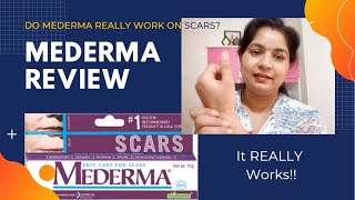 Mederma Cream Review for AcneBurn Scars and Stretch Marks [upl. by Letsyrhc]