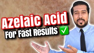 Azelaic Acid for Melasma  How to Use Azelaic Acid for SUCCESS 🏆 [upl. by Nidroj783]