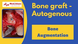 Autogenous Bone Grafts [upl. by Snave]