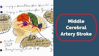 Middle Cerebral Artery Stroke [upl. by Nolitta84]