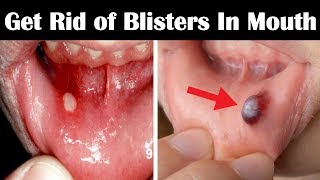 How to Get Rid of Blisters in Mouth Fast  Home Remedies for Blisters in Mouth and Tongue [upl. by Hilton862]