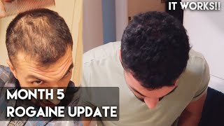 5 Month Rogaine Update Minoxidil  IT WORKS [upl. by Bethezel]