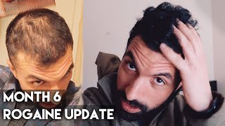 6 Month Rogaine Results Minoxidil [upl. by Rednael466]