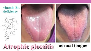 atrophic glossitis [upl. by Niall]