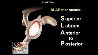 SLAP Tear  Everything You Need To Know  Dr Nabil Ebraheim [upl. by Rhodes]