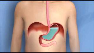 GastroEsophageal Reflux Disease GERD  Dr Gary Sy [upl. by Gothard]