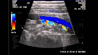 Introduction to the Lower Extremity Venous Doppler Study [upl. by Iolande]