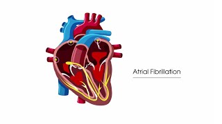 What is atrial fibrillation [upl. by Viki626]