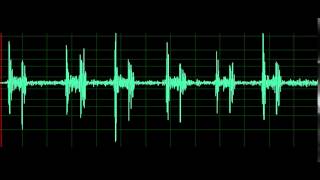 Pulmonary Associated Heart Sounds Tricuspid Regurgitation [upl. by Baillieu]