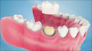 Dental Crown Procedure [upl. by Montano763]